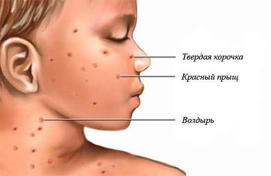 Стадии ветрянки