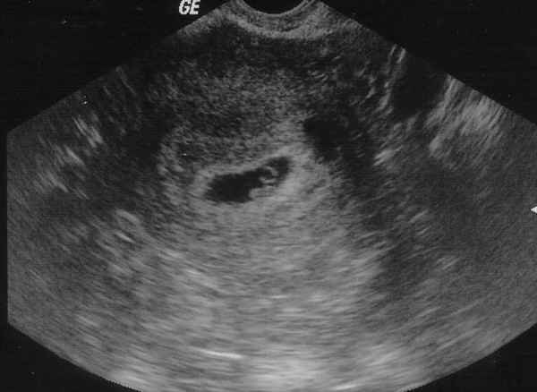 Имею ли я право на жизнь после того, как убила своего же ребенка?