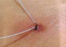 Удаление клещей