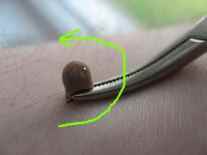 Удаление клещей